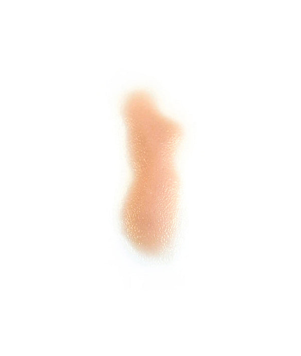 Swollen Right Nasolabial fold