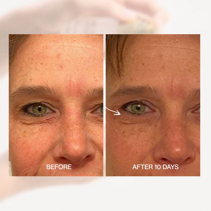 Before and after comparison of a person's eye area with text indicating improvement after 10 days.